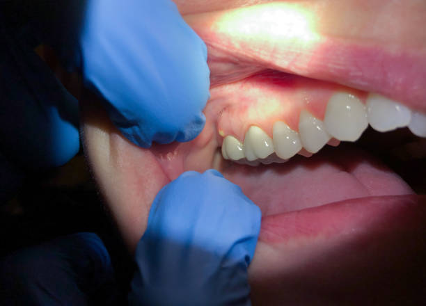 Best Emergency Care for Gum Disease in Mallory, WV